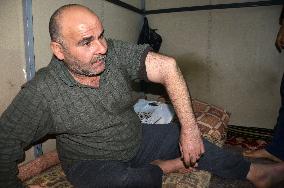 Iraqi refugee shows arm broken by Islamic State militants