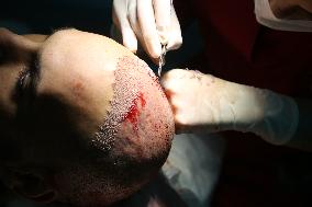 Hair Implants - Turkey