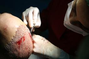 Hair Implants - Turkey