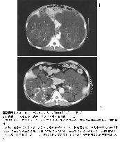 CT photos of kidney disease patient before and after therapy