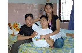 Separated Vietnamese conjoined twin Viet dies at 26