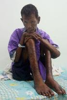 Leprosy patient in Indonesia