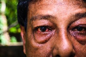 West Bengal Experiencing A Sudden Surge In Cases Of Conjunctivitis