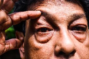 West Bengal Experiencing A Sudden Surge In Cases Of Conjunctivitis