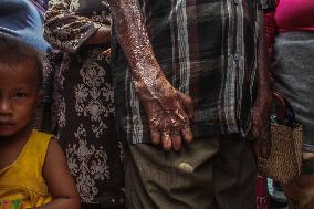 WHO: Beat Leprosy