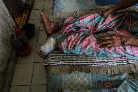 The Burden Of Leprosy In Indonesia