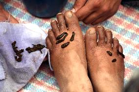 Leech Therapy On Nowruz Day In Kashmir