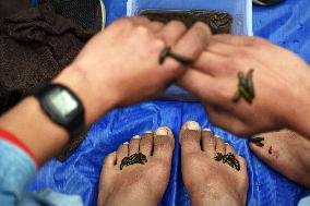 Leech Therapy On Nowruz Day In Kashmir