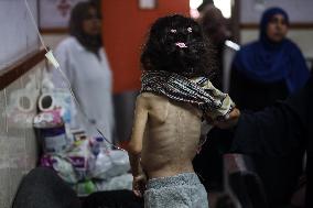 Malnutrition Issue in Gaza Amid Hamas-Israel Conflict