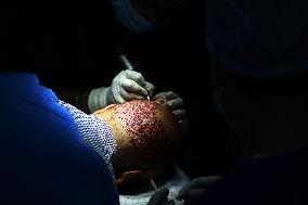 Hair Transplant In Kashmir
