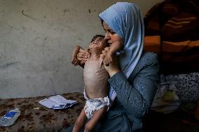 Severe Malnutrition and Dehydration Palestinian Children - Gaza