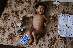 Severe Malnutrition and Dehydration Palestinian Children - Gaza