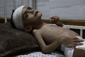 Palestinian Children Suffering From Malnutrition - Gaza