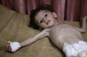 Palestinian Children Suffering From Malnutrition - Gaza