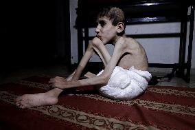 Children's Lives Threatened By Rising Malnutrition - Gaza