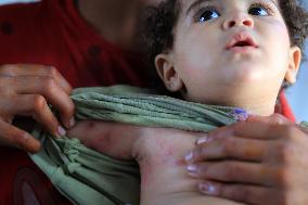 MIDEAST-GAZA-CHILDREN-SKIN DISEASE