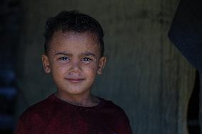 MIDEAST-GAZA-CHILDREN-SKIN DISEASE