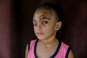 Palestinian Girl Injured During School Bombardment - Gaza