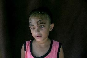 Palestinian Girl Injured During School Bombardment - Gaza