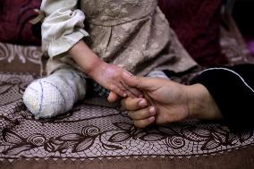 War Leaves Child Amputees Helpless In Deir al-Balah - Gaza