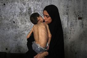 Children malnutrition in Gaza