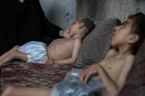 Children malnutrition in Gaza