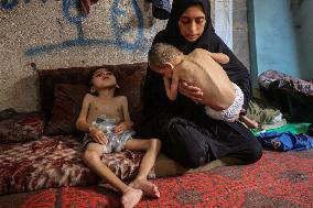 Children malnutrition in Gaza