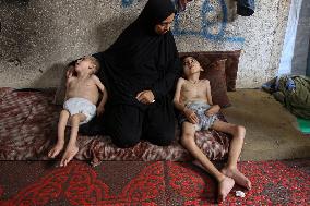 Children malnutrition in Gaza