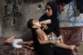 Children malnutrition in Gaza