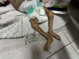 Infant Dies of Malnutrition in Hospital - Khan Yunis