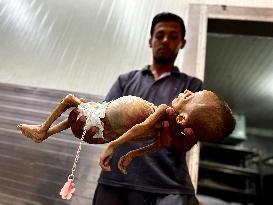 Infant Dies of Malnutrition in Hospital - Khan Yunis