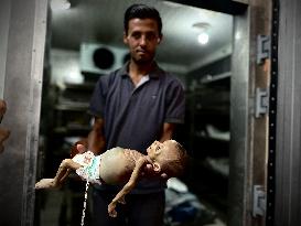 Infant Dies of Malnutrition in Hospital - Khan Yunis