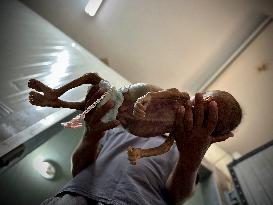 Infant Dies of Malnutrition in Hospital - Khan Yunis
