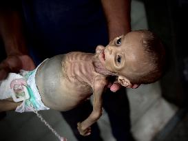 Infant Dies of Malnutrition in Hospital - Khan Yunis