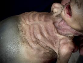 Infant Dies of Malnutrition in Hospital - Khan Yunis