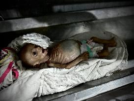 Infant Dies of Malnutrition in Hospital - Khan Yunis