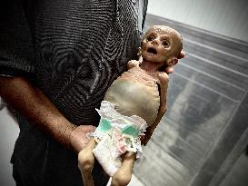 Infant Dies of Malnutrition in Hospital - Khan Yunis
