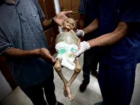 Infant Dies of Malnutrition in Hospital - Khan Yunis