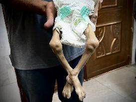 Infant Dies of Malnutrition in Hospital - Khan Yunis