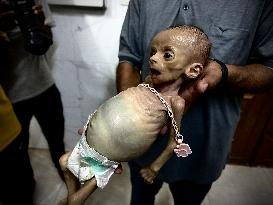 Infant Dies of Malnutrition in Hospital - Khan Yunis