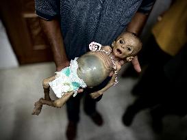 Infant Dies of Malnutrition in Hospital - Khan Yunis