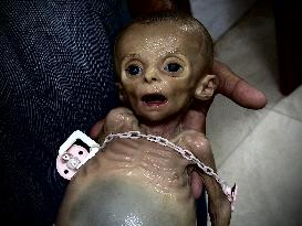 Infant Dies of Malnutrition in Hospital - Khan Yunis