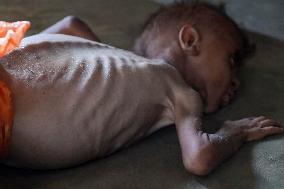 Malnourished Baby Highlights Gaza Crisis