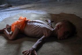 Malnourished Baby Highlights Gaza Crisis