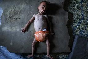 Malnourished Baby Highlights Gaza Crisis