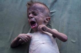 Malnourished Baby Highlights Gaza Crisis