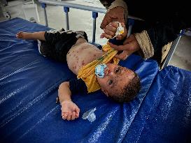 Gaza Children Skin Diseases - Khan Yunis