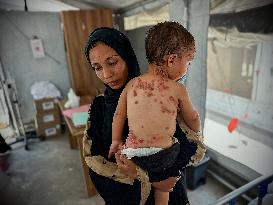 Gaza Children Skin Diseases - Khan Yunis