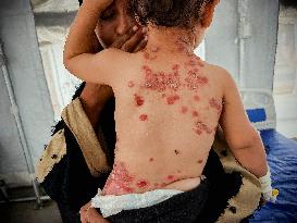 Gaza Children Skin Diseases - Khan Yunis
