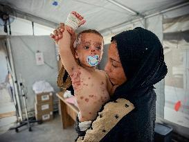 Gaza Children Skin Diseases - Khan Yunis